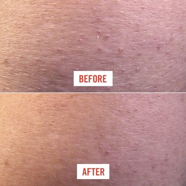 Exfoliante corporal, borra protuberancias, con 10 % AHA, vegano, para descongestionar los poros y exfoliar suavemente la piel, 8 onzas - Imagen 3